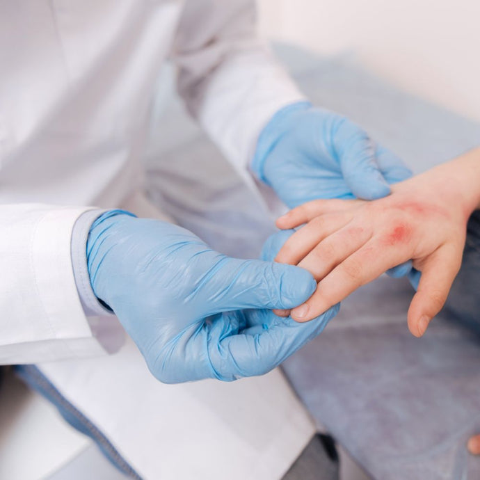 Understanding Allergic Reactions to Disposable Gloves and How to Choose the Best Gloves for Skin Sensitivities